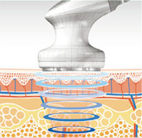 キャビテーション