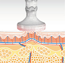 サイクロン吸引