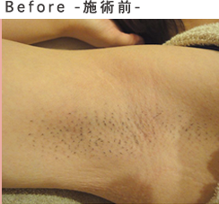 Before-施術前-